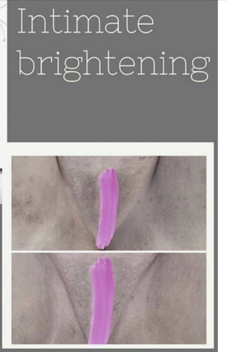 Vaginal Brightening 